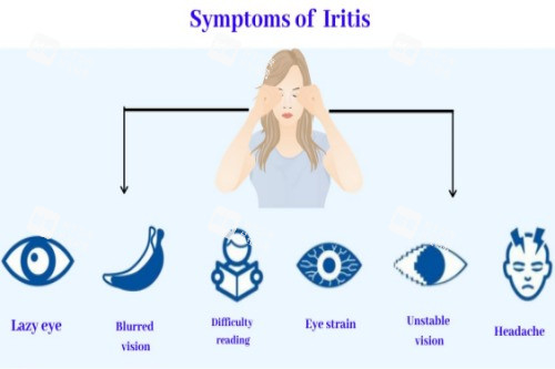 虹膜炎症状 虹膜炎症状