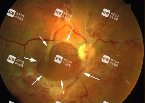 视网膜脱落细节表现图 视网膜脱落细节表现图