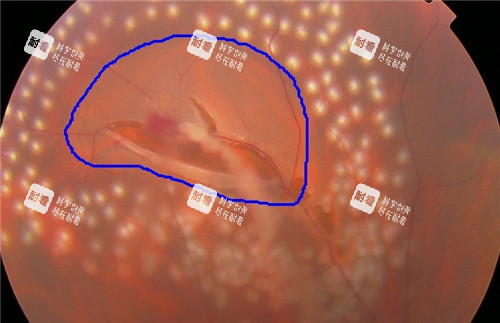 视网膜脱落细节图片 视网膜脱落细节图片