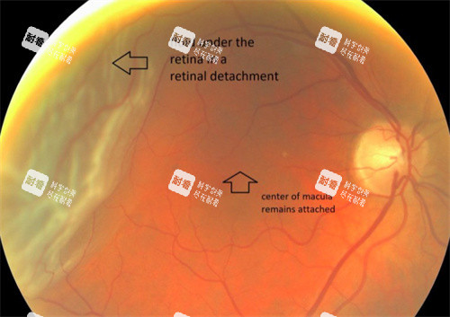 视网膜脱落检查 视网膜脱落检查