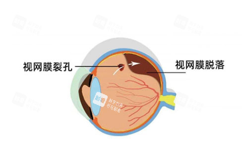 视网膜脱落卡通图片展示 视网膜脱落卡通图片展示