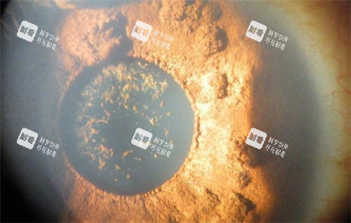 虹膜缺损病变 虹膜缺损病变