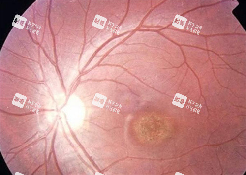虹膜炎图片 虹膜炎图片