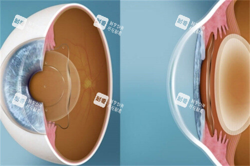 ICL晶体切面图 ICL晶体切面图