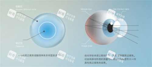 离焦软镜设计原理图 离焦软镜设计原理图