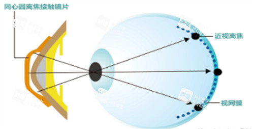 离焦软镜原理图示 离焦软镜原理图示