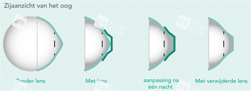 角膜塑形镜改善圆锥角膜 角膜塑形镜改善圆锥角膜