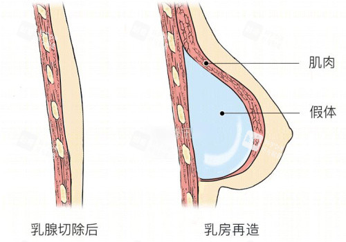 胸再造示意图 胸再造示意图