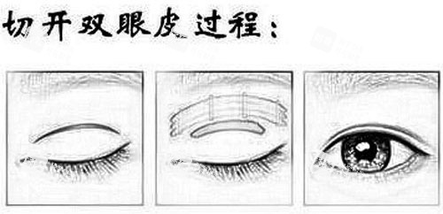切开双眼皮 切开双眼皮