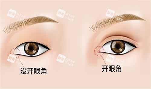 开眼角前后对比图 开眼角前后对比图