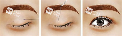 正在进行的双眼皮手术 正在进行的双眼皮手术