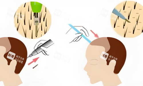 后枕部位取毛囊植发展示 后枕部位取毛囊植发展示