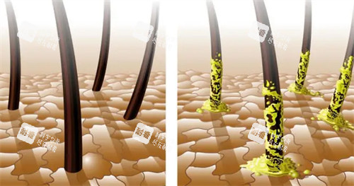 健康毛囊与脂溢性毛囊的区别对比图 健康毛囊与脂溢性毛囊的区别对比图