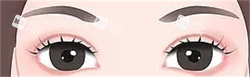 双眼皮术后示意图 双眼皮术后示意图