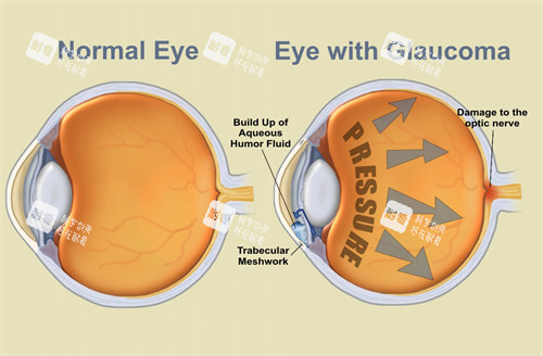 青光眼治疗图示 青光眼治疗图示