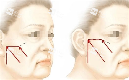 微拉美面部提升方向 微拉美面部提升方向