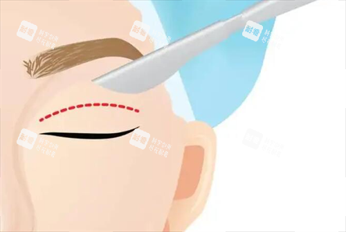 割双眼皮示意图 割双眼皮示意图