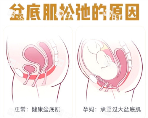 盆肌底松弛的原因 盆肌底松弛的原因