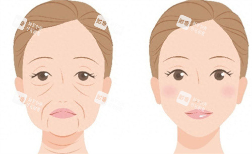 面部提升术 面部提升术