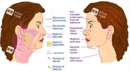 面部提升手术对比图 面部提升手术对比图