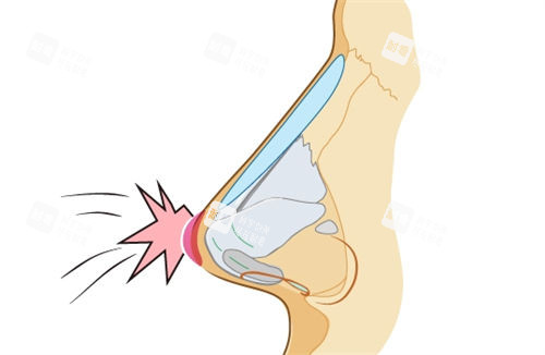 隆鼻假体鼻背动画展示图 隆鼻假体鼻背动画展示图