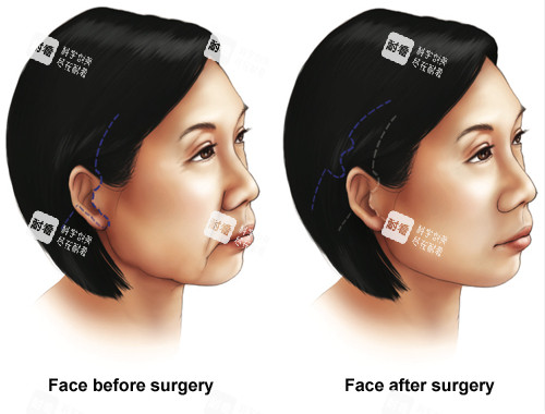 面部提升手术前后对比图 面部提升手术前后对比图