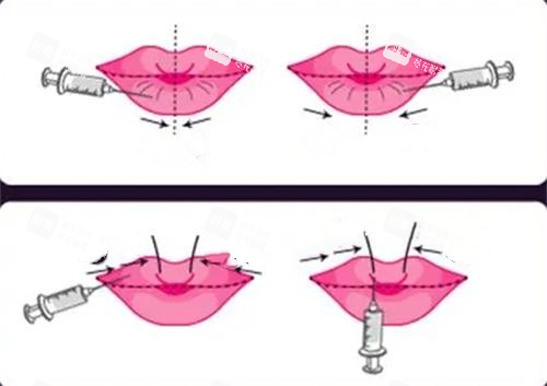 玻尿酸丰唇前后对比图