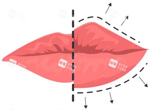 唇部整形示意图
