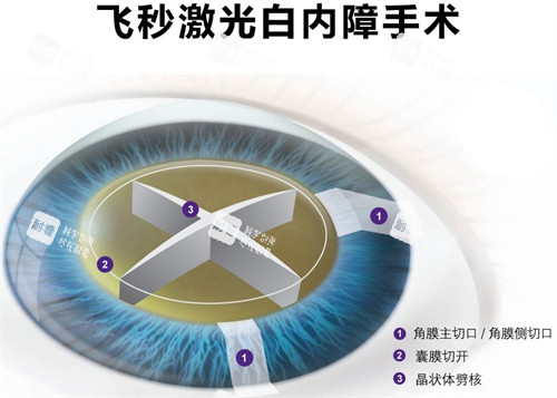 飞秒白内障手术细节图