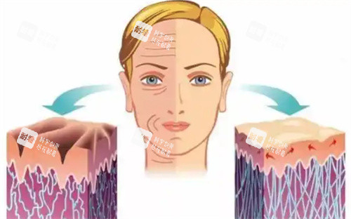 微拉美提升手术前后