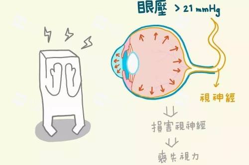 青光眼概念图片