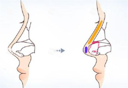 鼻尖鼻梁隆鼻手术前后对比图