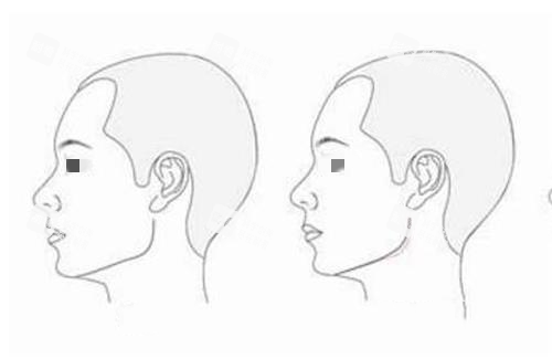 磨骨前后对比图