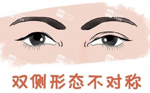 双眼皮形态不对称