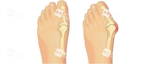 大脚骨手术前后对比