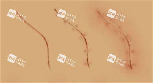 疤痕照片 疤痕照片