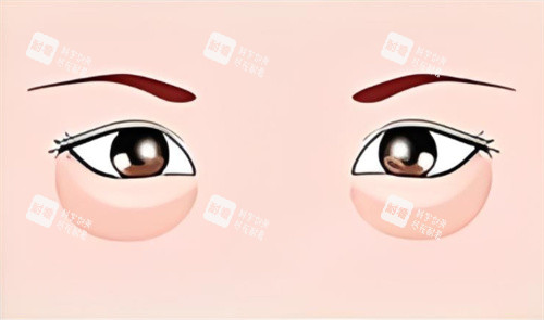 眼袋的示意图 眼袋的示意图