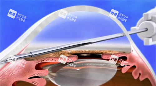 青光眼引流阀植入手术