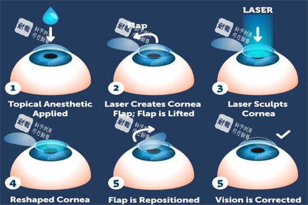 激光治疗近视眼动画图