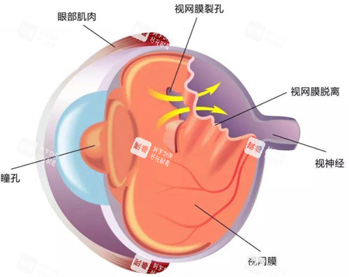 视网膜脱落展示图