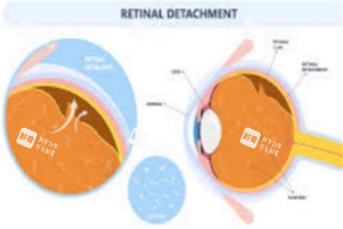 视网膜脱离图示