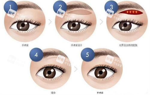提眉手术怎么做的