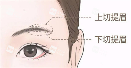 提眉手术不同切口
