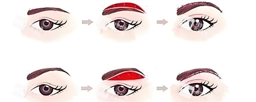 常规提眉手术步骤动画演示图