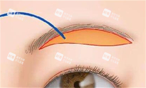 提眉手术的切口部位