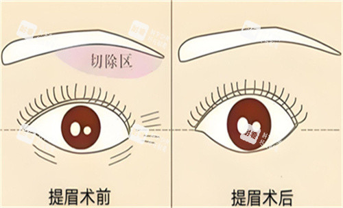 提眉手术前后对比