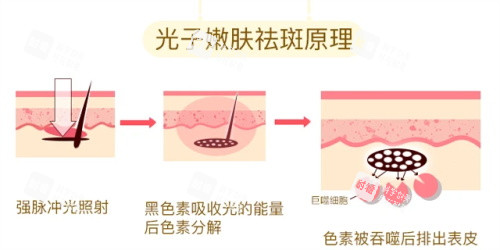 光子嫩肤的祛斑原理