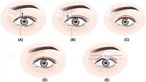 调整双眼皮宽度