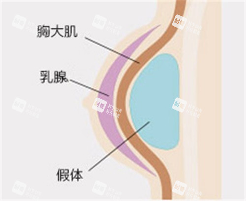 隆胸示意图 隆胸示意图