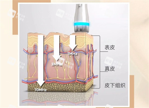 LDM水滴提升是什么